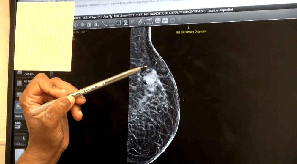 Mes del cáncer de mama: cómo y dónde se puede hacer el examen preventivo sin costo